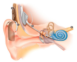 Cochlear implant (CI)